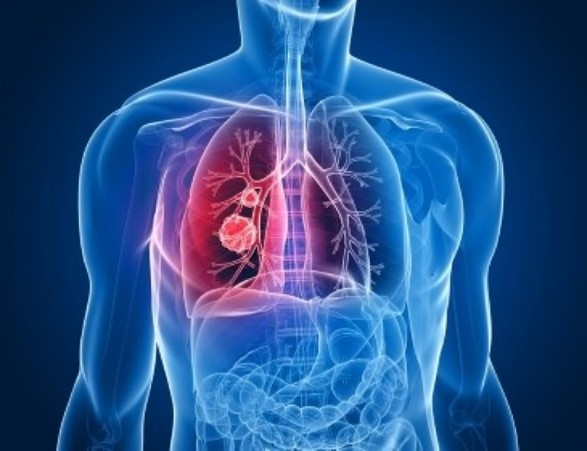 Lung Cancer Doctors in Delhi NCR
